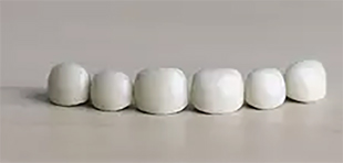 Acero ES White Resin Crown