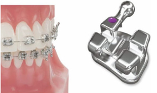 Votion Metal Brackets 022 LL3