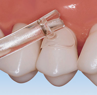 Cure-Thru Clear Cervical