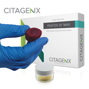 PentOs Ol Max Allograft