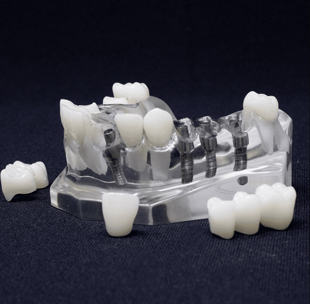 Dual Crown and Bridge Implant