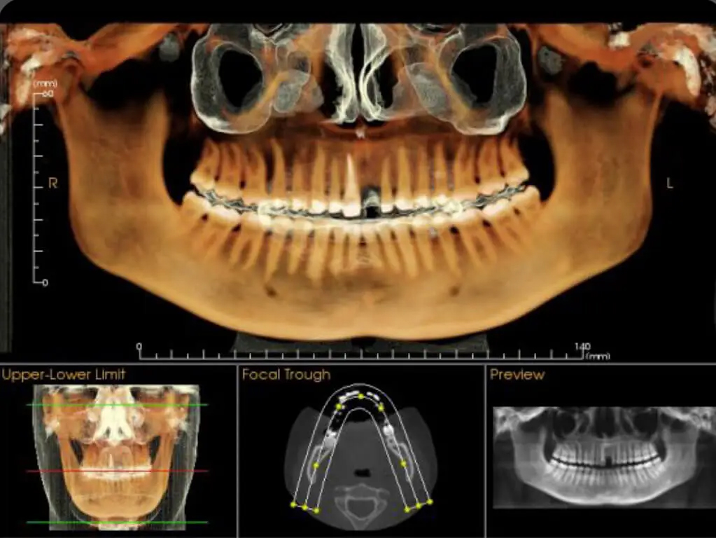 CBCT scan