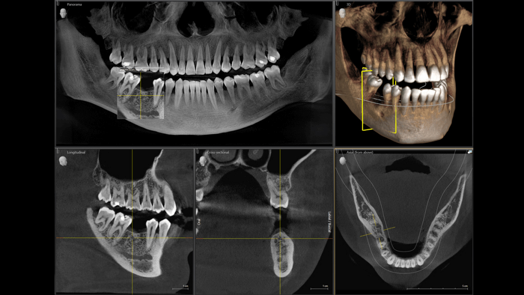 CBCT scan