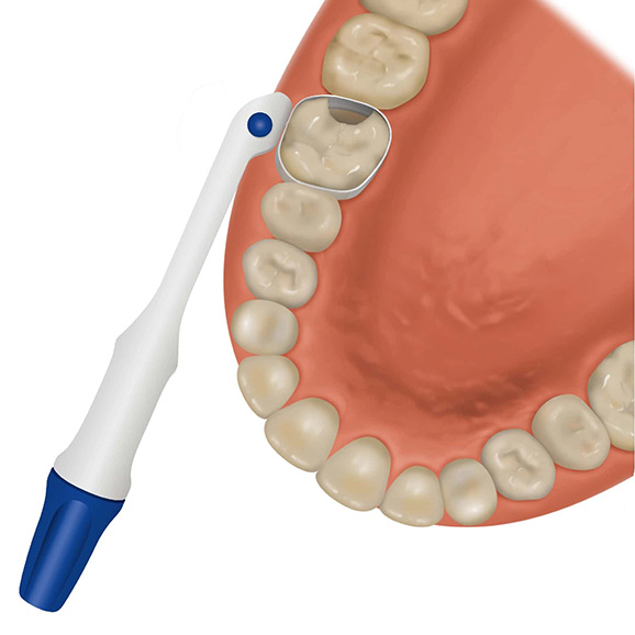 dental matrix safematrix_tooth restorative