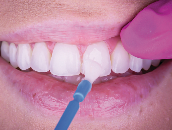 dental-hygiene-fluoride-varnish-supplies
