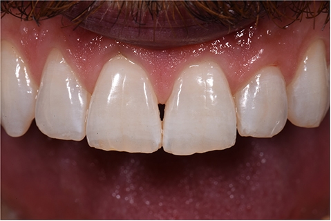 teeth_restorative-SDI-aura-easyflow_1