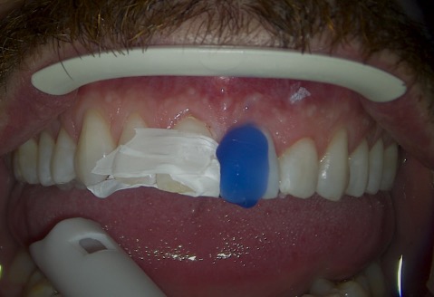 teeth_restorative-SDI-aura-easyflow_3