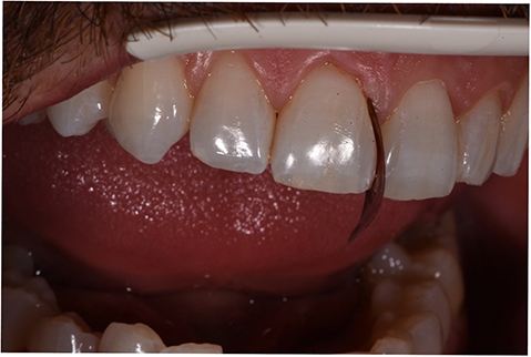 teeth_restorative-SDI-aura-easyflow_4