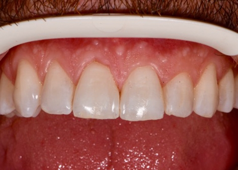 teeth_restorative-SDI-aura-easyflow_6